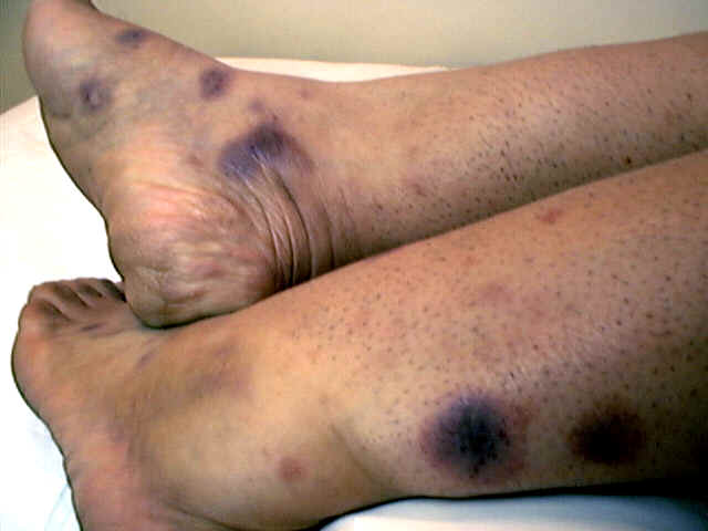 Common Rashes of the Feet - When to seek treatment