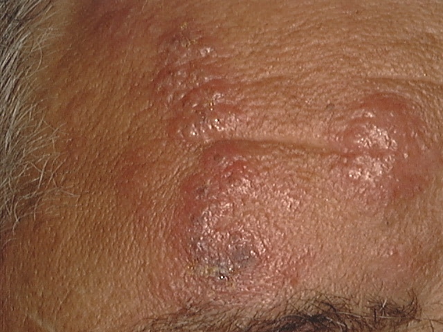 Herpes First Stage