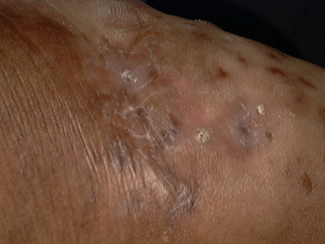 Urticarial lesions: If not urticaria, what else? The ...