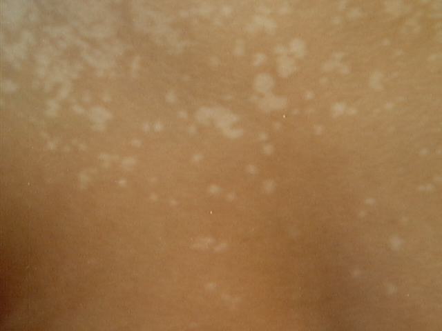 pityriasis versicolor bilder 1