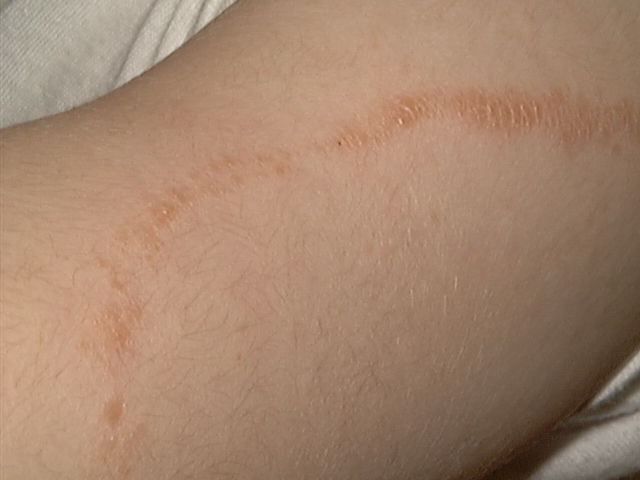 A rash that forms a straight line - HealthcareMagic