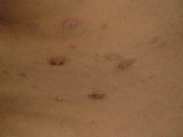 Why does lupus create lesions on the skin?