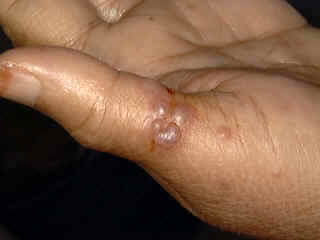 Herpes Whitlow Mild