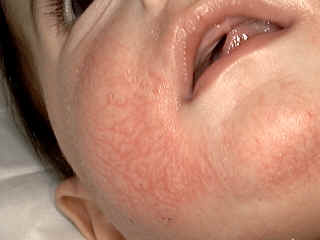 Steroid induced facial rash