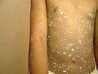 Steroid treatment for guttate psoriasis