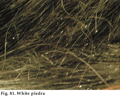 Principles Of Pediatric Dermatology Chapter10 Fungal Skin