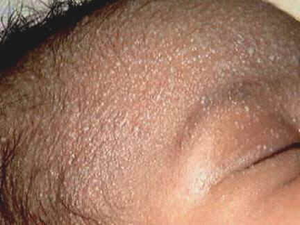 infantile psoriasis